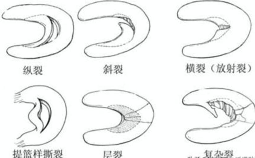 运动不当 膝盖疼到无法打球 小心半月板撕裂 这套自我检查方法您可以了解一下 健康号 微医