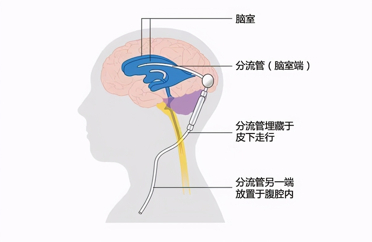 脑积水分流手术术后管子还需要更换吗