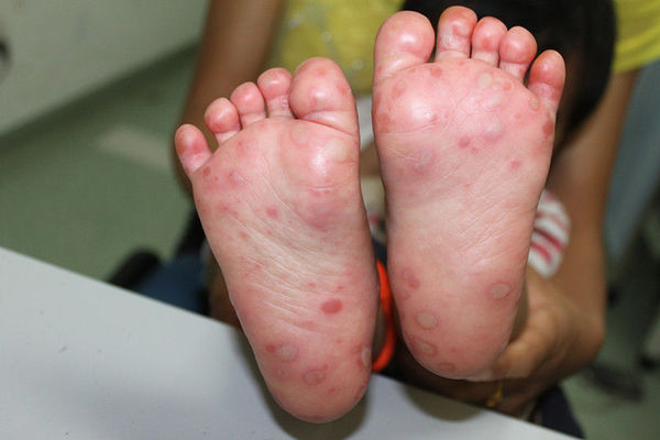 小儿手足水疱需警惕 - 微医(挂号网)