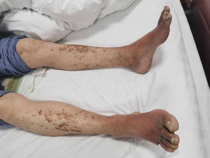 下肢缺血神经痛夜不能寐一根电极即刻解除糖足大问题