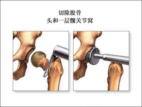东方医院骨科髋关节置换术
