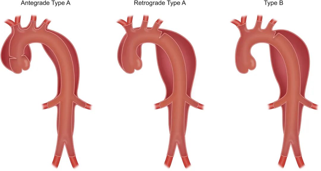 b型主动脉夹层perfusion灌注vsperfection完善哪个更重要