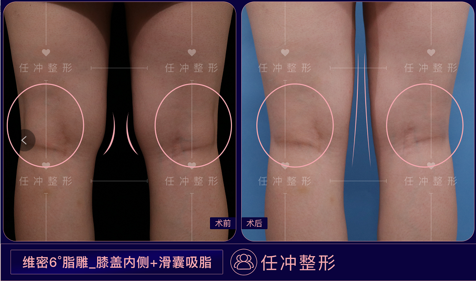大腿吸脂后不对称凹凸不平怎么修复
