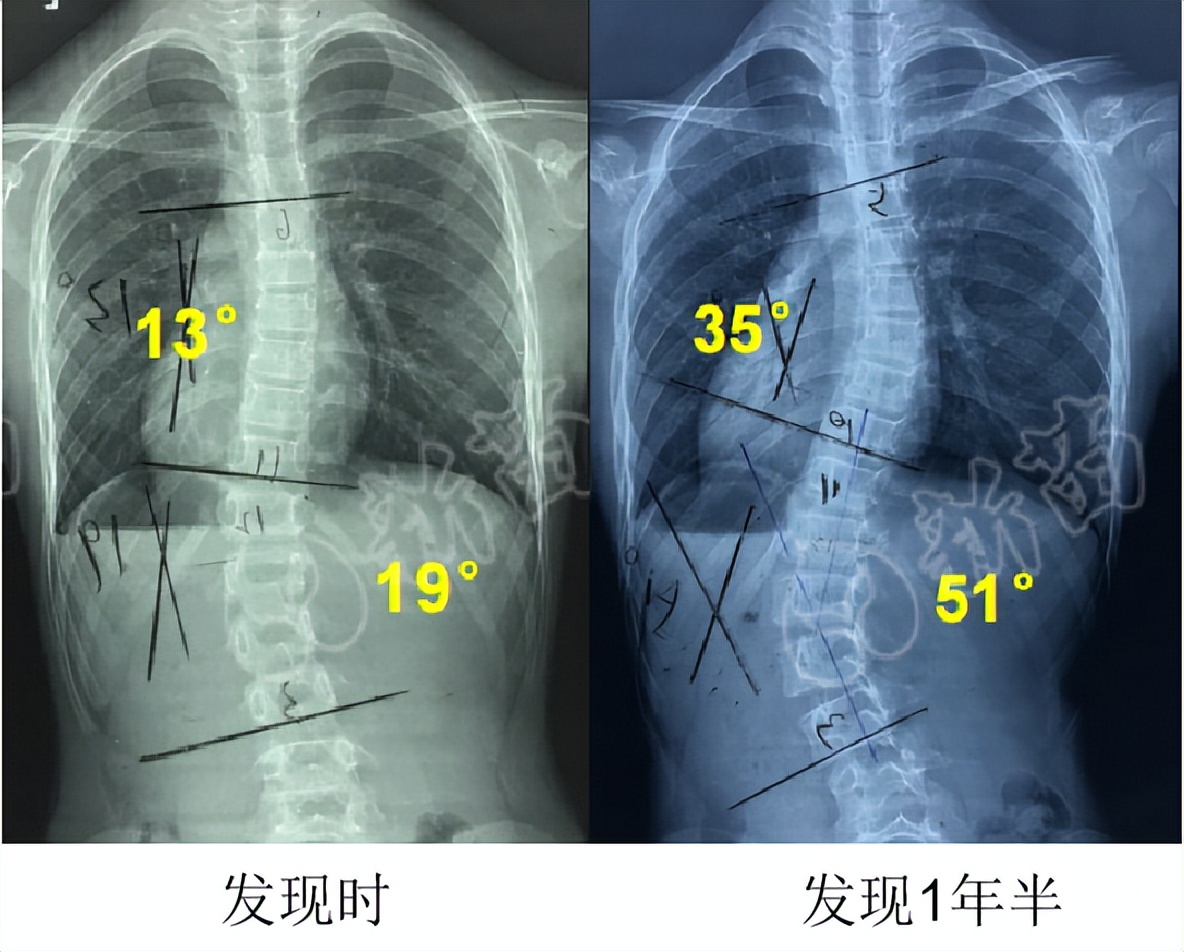 你看下面的案例:但是6个月或1年后再次拍片发现,脊柱侧弯度数直接翻倍