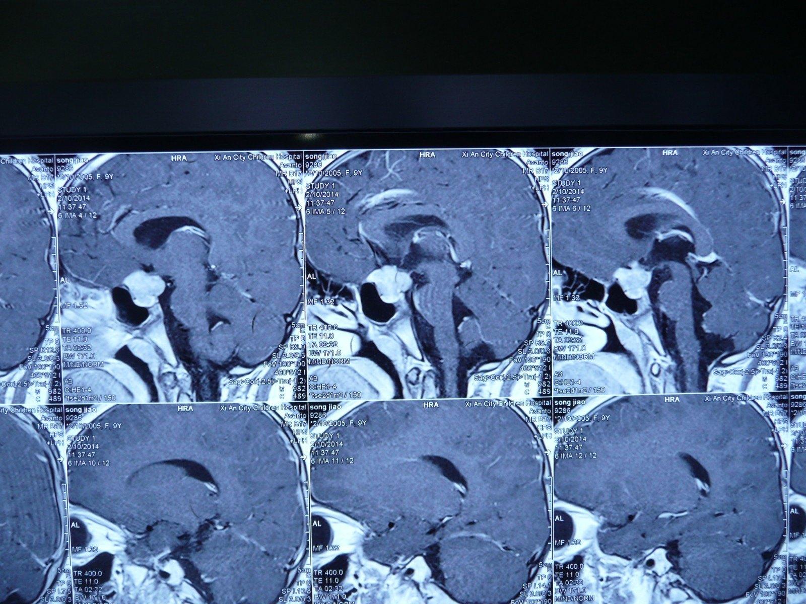 贺晓生教授儿童垂体腺瘤的诊断和手术案例