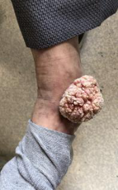 脚踝上的一颗花菜——疣状癌 