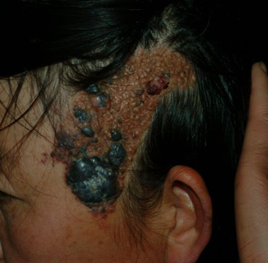 会遗传的表皮痣