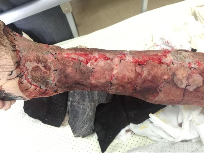 橡皮腿上恶性黑色素瘤的治疗 - 微医(挂号网)