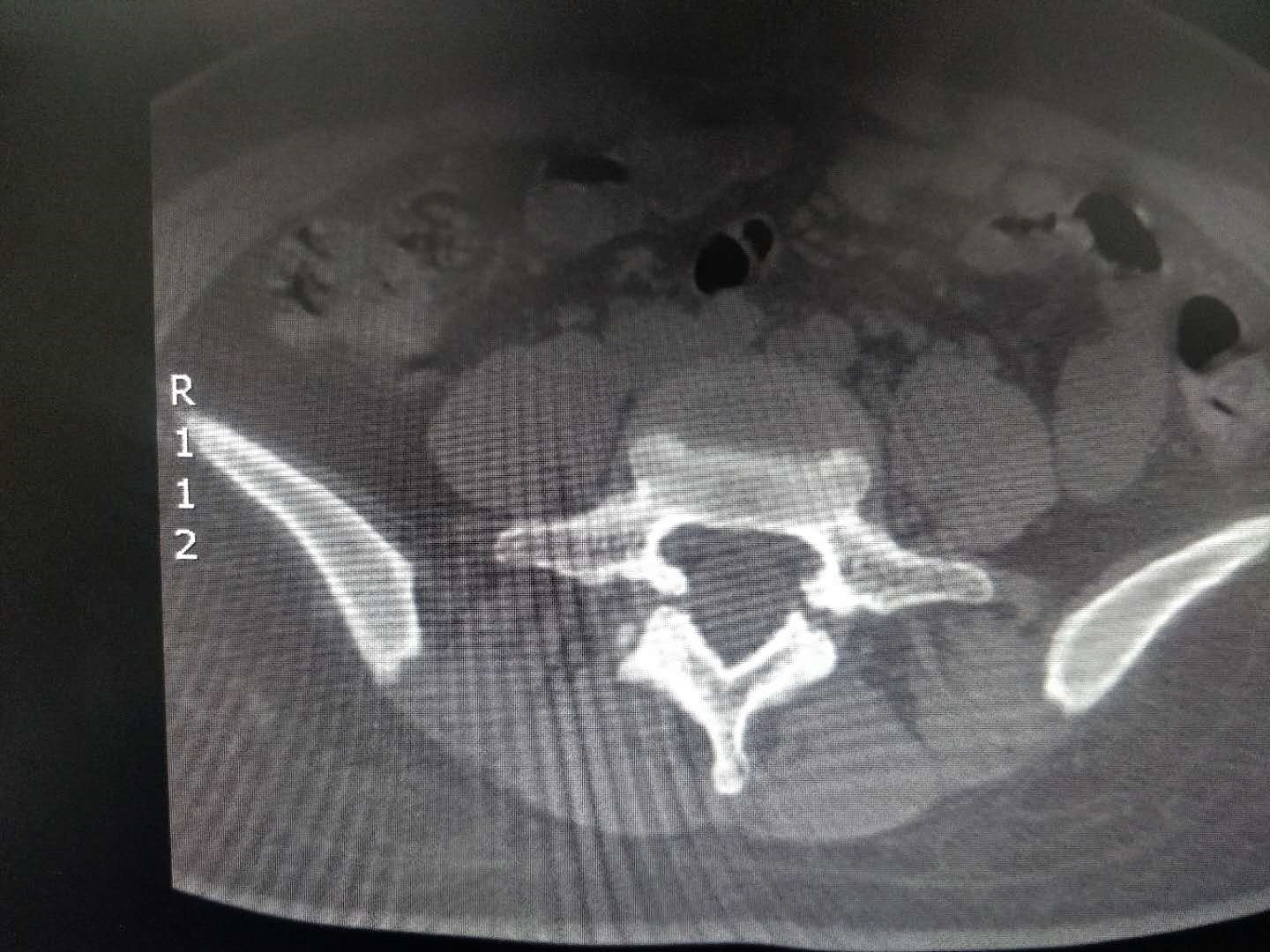 椎弓峡部CT图片