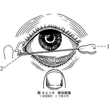流泪有眼屎的孩子为什么需要冲洗泪道或者泪道探通?