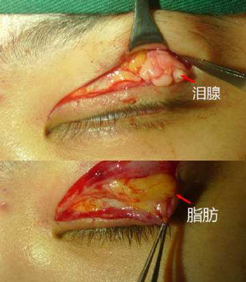 你以为只是肿泡眼当心还有泪腺脱垂