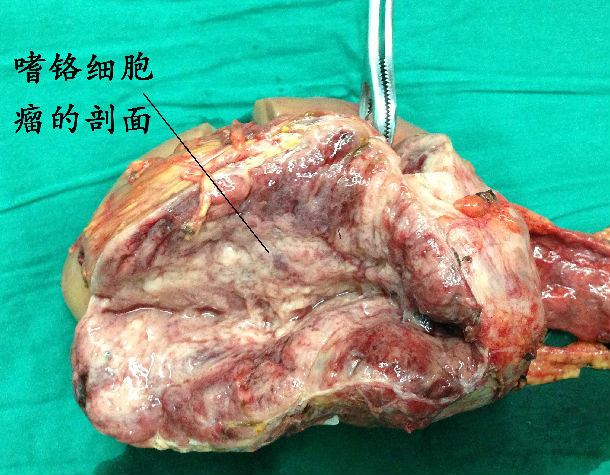 一例与肾脏相连的巨大嗜铬细胞瘤