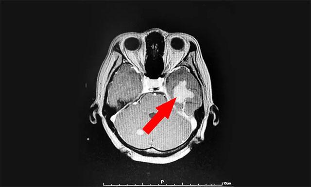 囊性腦轉移瘤患者不耐受手術怎麼辦可考慮立體定向穿刺引流聯合伽瑪刀