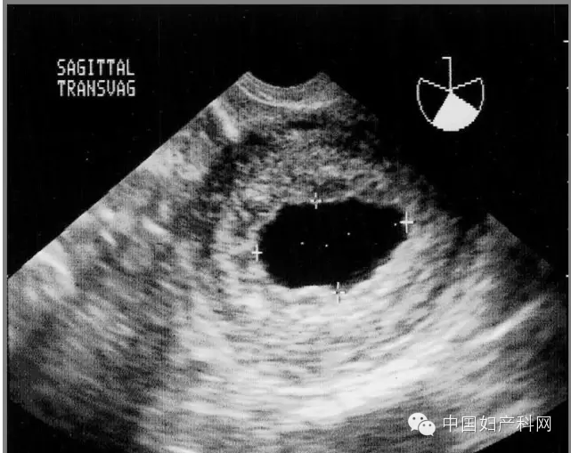 早期胚胎停育多少人的痛