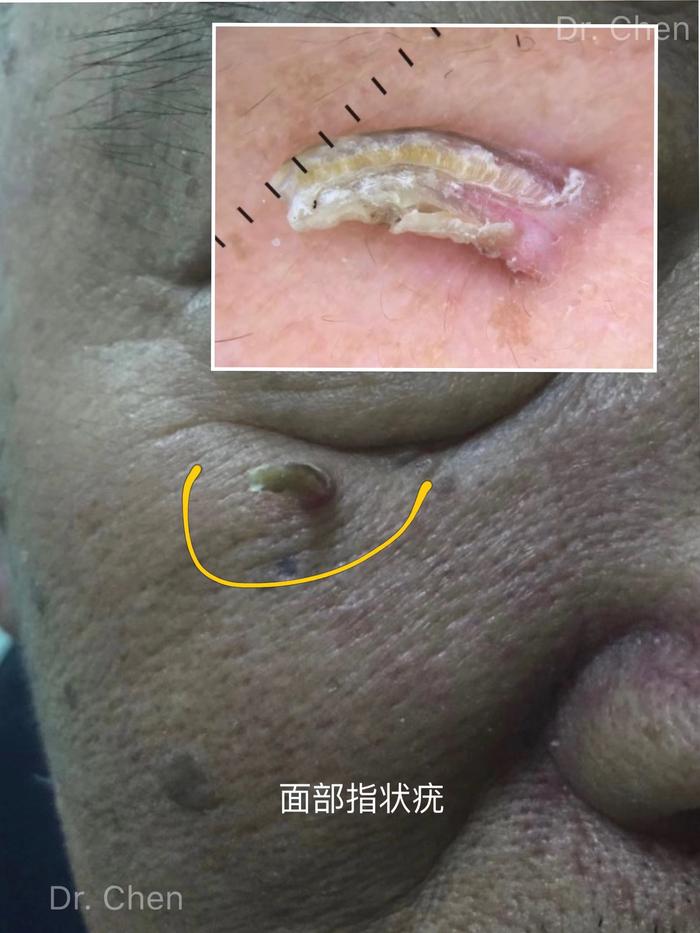 图5 面部指状疣4)位于头皮部位的疣:表现为头皮局部的赘生物,表面粗糙