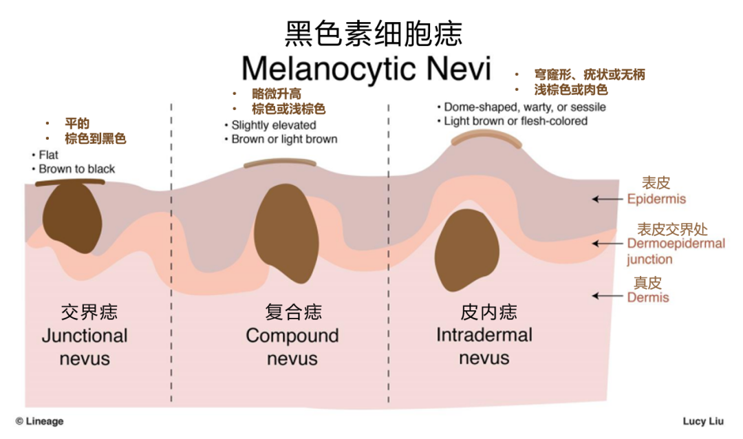 痣的类型和深度不同类型的黑痣组织深度不同,手术切除深度也不同.
