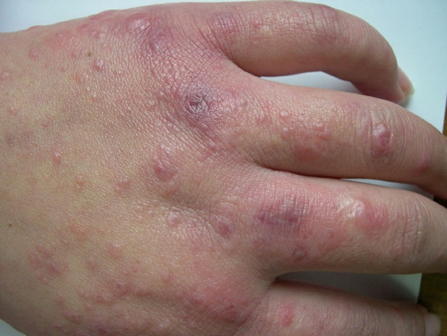 寒冷性多形红斑浸渍足 (图片来自uptodate)冻伤导致脚趾坏死 (图片