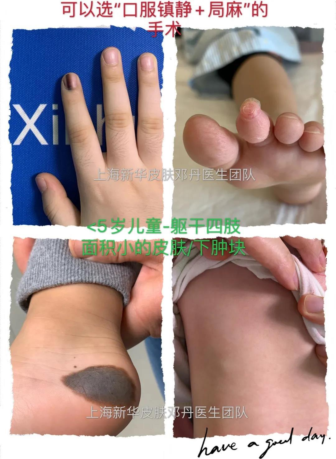 儿童手术麻醉之—静脉镇静 局麻