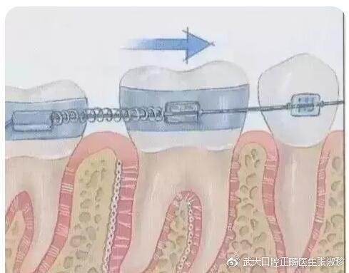 牙齿矫正的原理,原来牙套是这样移动的!