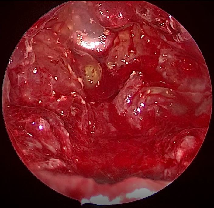 内镜微创手术鞍区巨大蘑菇云样肿瘤一例