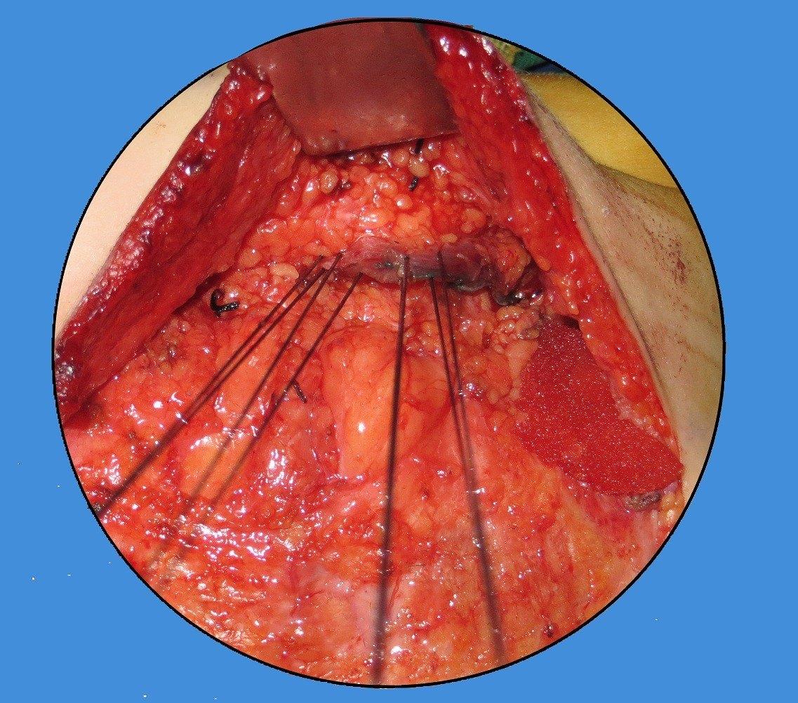 moebius莫比乌斯综合征是什么鬼先天性面瘫怎么治