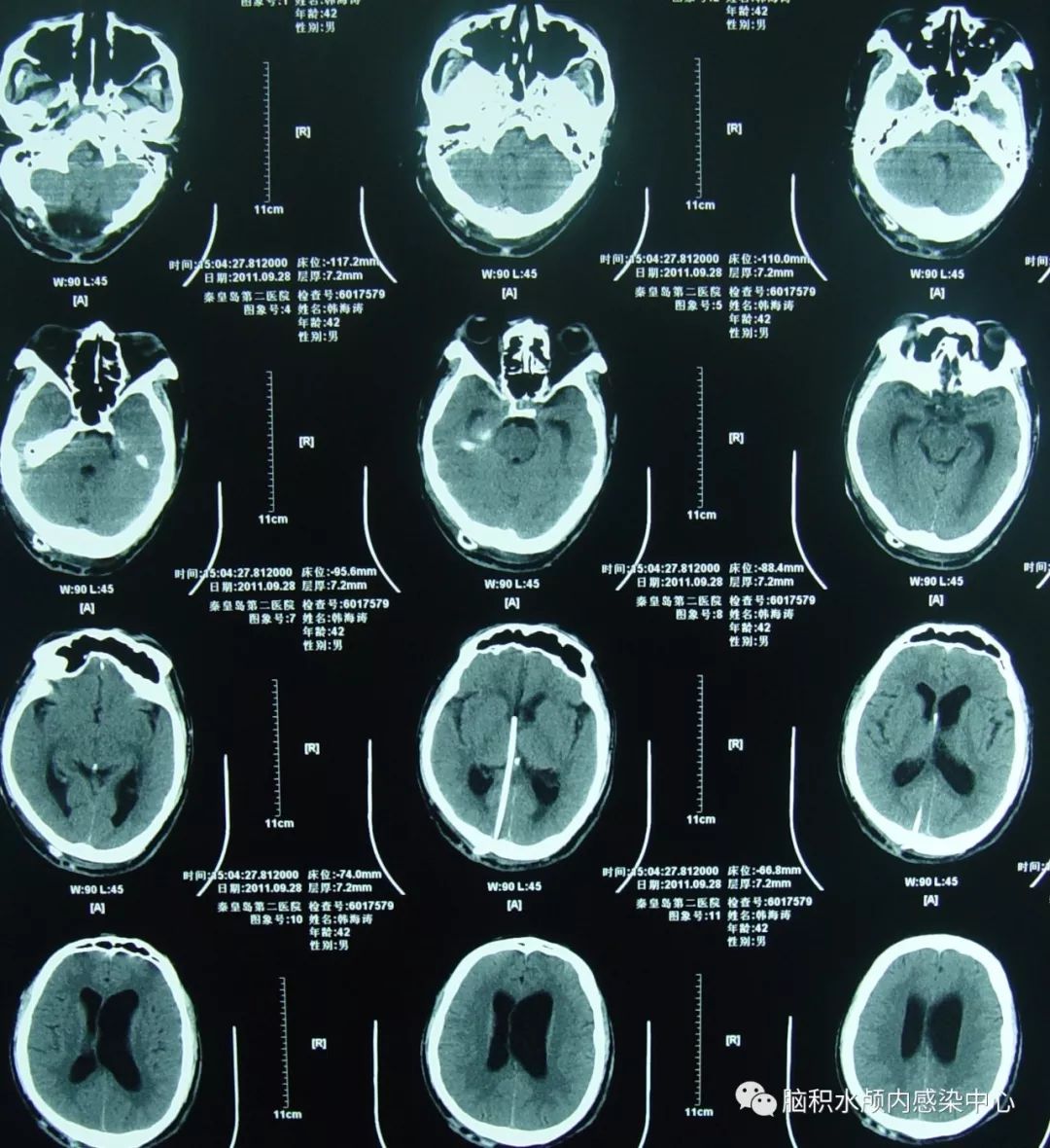 脑脊液科治愈一例小脑扁桃体下疝脊髓空洞枕下减压术后假性.