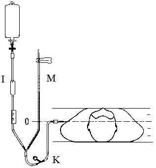 测量中心静脉压cvp的零点问题