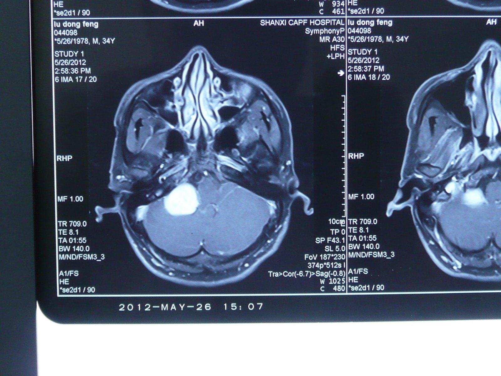 贺晓生教授右桥小脑角听神经瘤切除案例