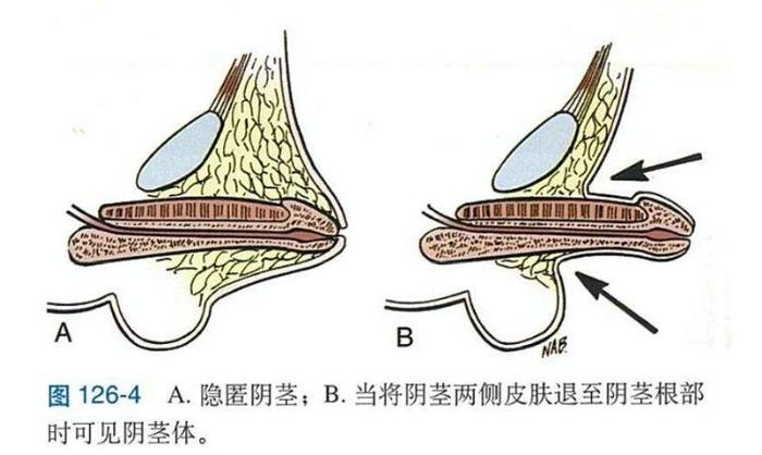 男性隐匿性阴茎可以注射玻尿酸ha增大吗