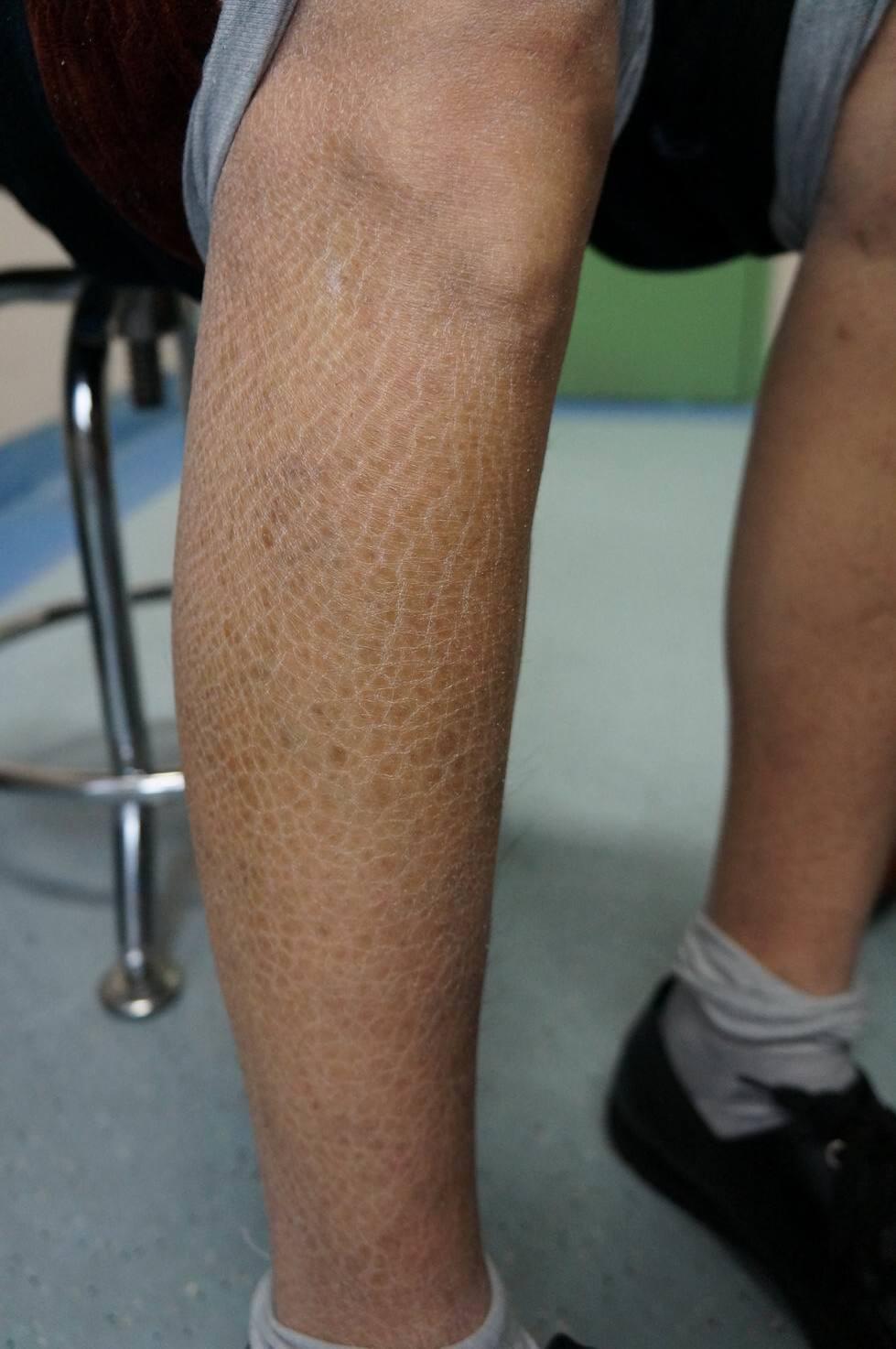 成年鱼鳞病要警惕恶性肿瘤