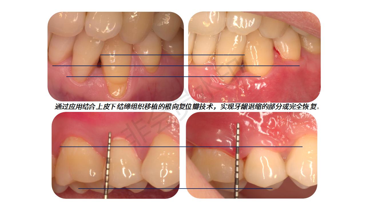 牙龈萎缩与牙槽骨破坏的关系牙周健康的原理1