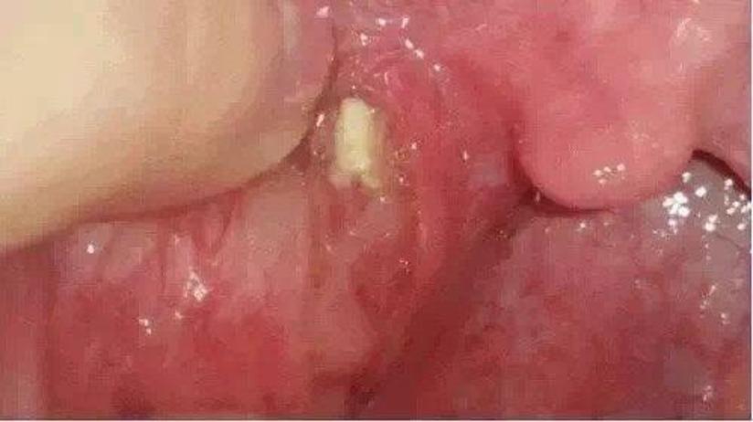 藏在扁桃体里的小石头 健康号 微医