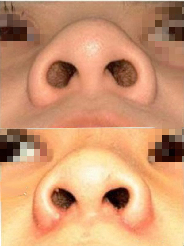 为什么有的人做完鼻翼缩小没效果