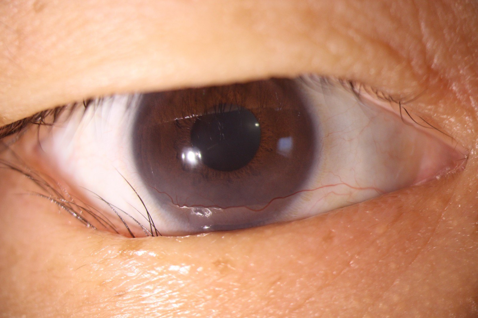 任性眼睑内翻本是护卫反戳主人多图