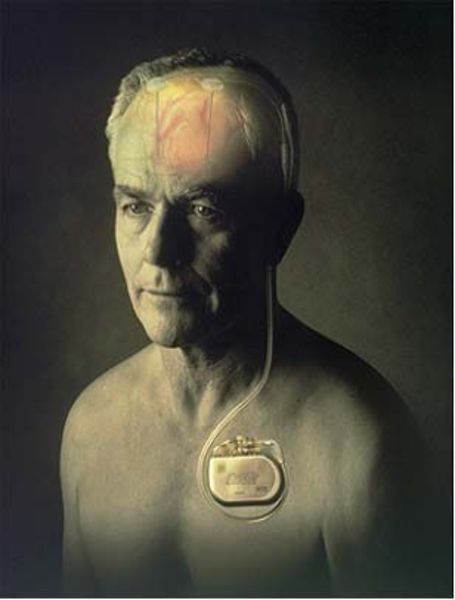 脑起搏器实物图片