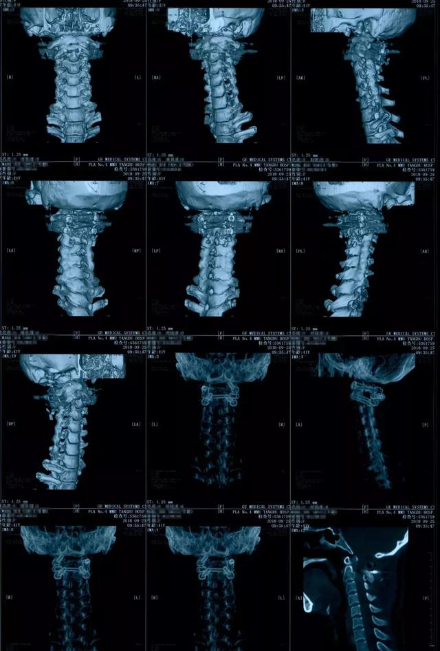 病例点评寰枢椎脱位1例