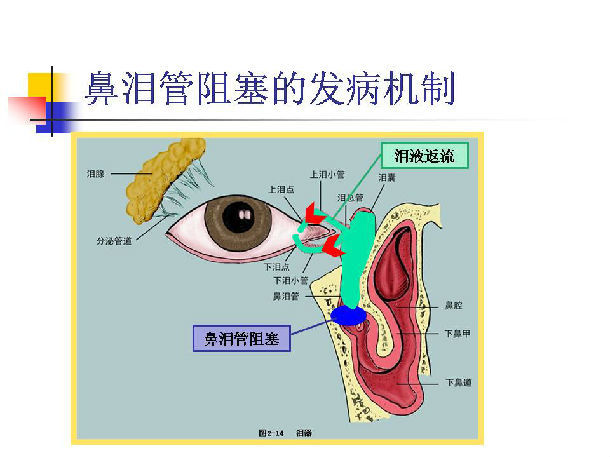 图说-----泪道阻塞性疾病的发病机制和治疗方法选择 - 微医(挂号网)