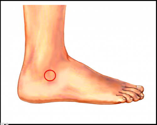 跗骨窦综合症特征是外踝前下方的局部疼痛和压痛