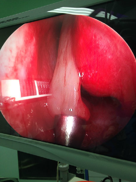 ④儿童睡眠呼吸暂停综合征简要病情:患者徐某某,女,5岁,主因"睡眠时