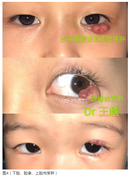 但残留的部分会形成皮肤面,睑缘面或者结膜面的肉芽肿(图3,4),皮肤溃