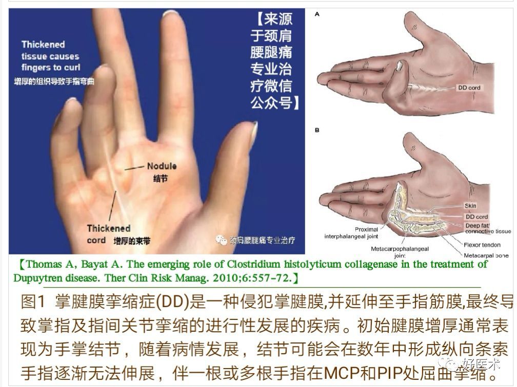 掌腱膜挛缩症的诊治技巧,系统详解!