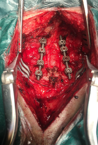 颈椎髓内肿瘤切除椎管切除减压多节段侧块螺钉内固定