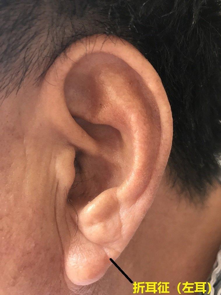 耳垂有折痕和冠心病有关系吗?