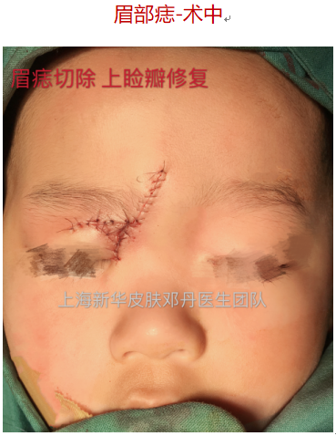 病例系列08眉部痣切除vs皮瓣修复