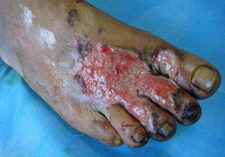 脚趾头发黑坏死差点截肢以为是糖尿病结果是吸烟惹的祸