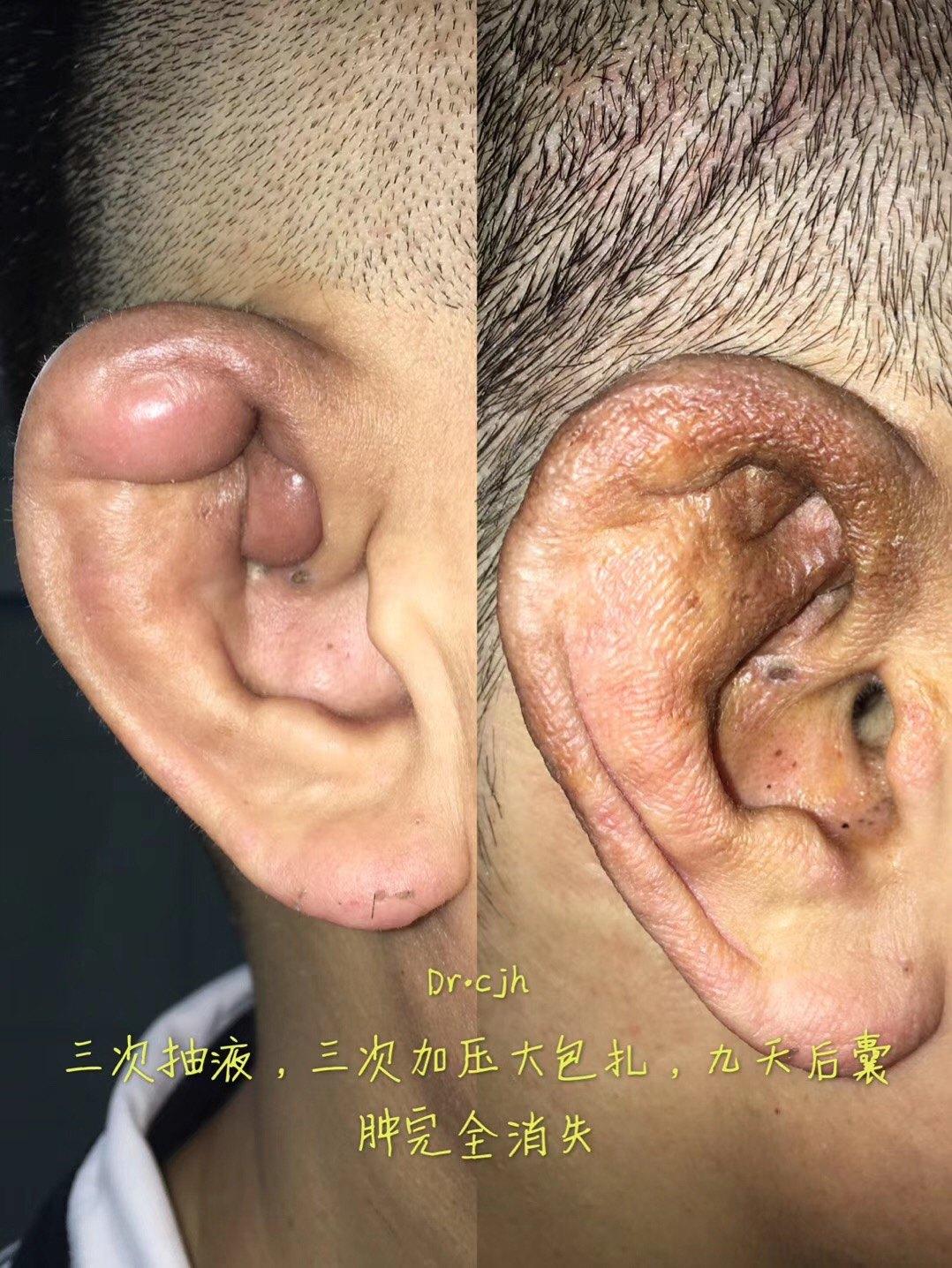 图6   男性患者,36岁,三次抽液体,三次加压包扎,共9天治愈,2018.7.