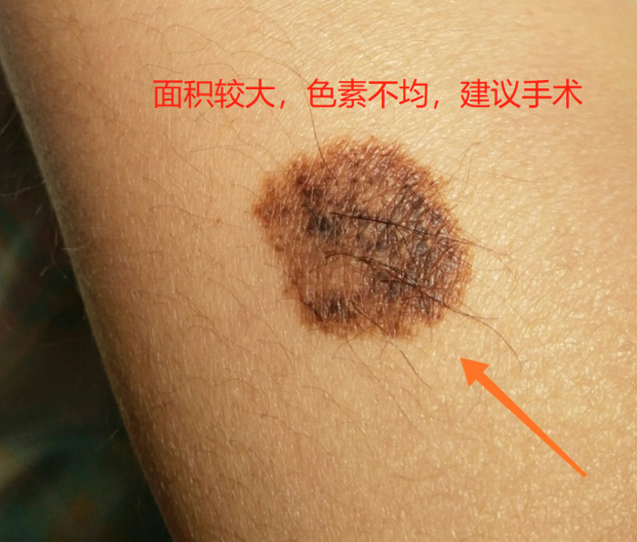 而大于20厘米的巨痣,恶变概率大约5%甚至更高