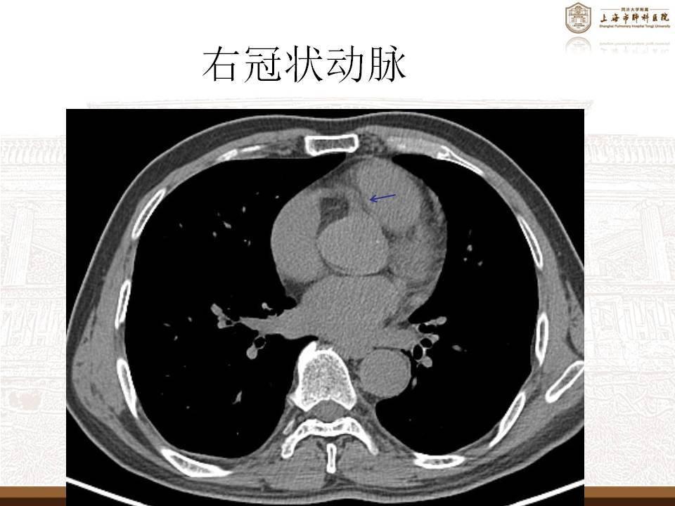 图片描述图片描述图片描述ct片子里的冠脉钙化是指ct里沿冠脉走行分布