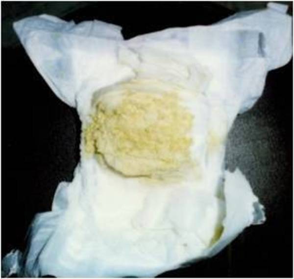 如何进一步提高我国大陆地区胆道闭锁的生存率_郑珊医生文章_复旦大学