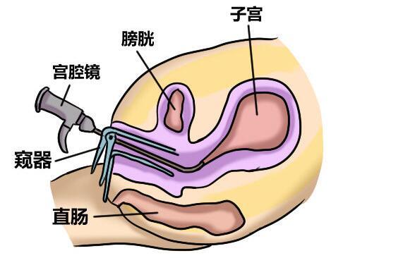 镜下子宫瘢痕憩室表现子宫峡部前壁切口或宫颈管上三分之一处的带状